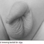 1- İnmemiş testis (yumurta) nedir?