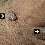 9- Siğillerin tedavisi nasıl oluyor?