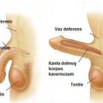 1 – Sertleşme sorunu nedir?