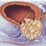 10- İyi huylu prostat büyümesi (BPH) teshisi nasıl konur?